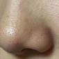 いちご鼻の治し方